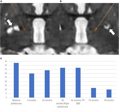 Deep Brain Stimulation of the Forel’s Field for Dystonia: Preliminary Results